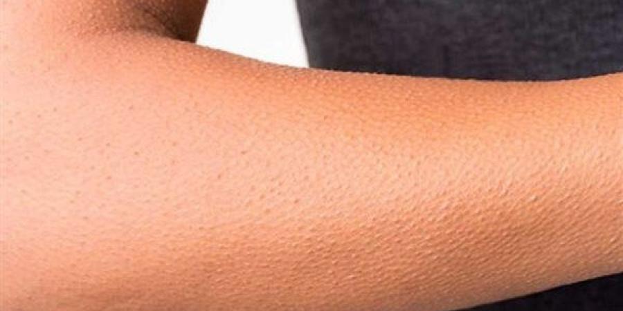نصائح للحماية من الإصابة بجلد الوزة